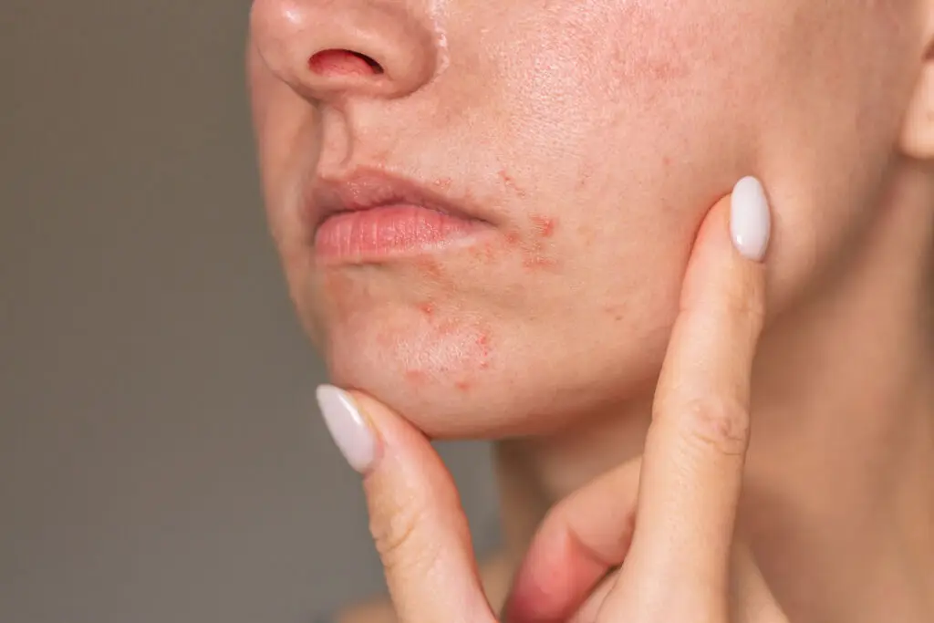 Hvad er perioral dermatitis?