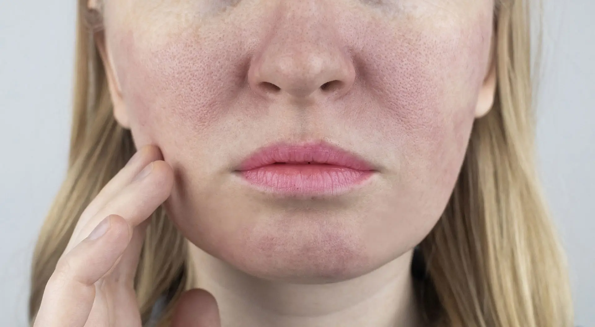 Hvad er rosacea?