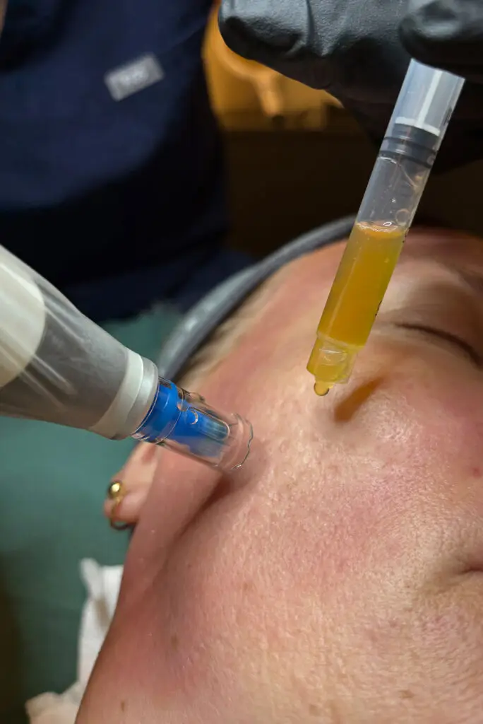 Microneedling med PRF behandling i ansigtet hos Graceful Space på Østerbro